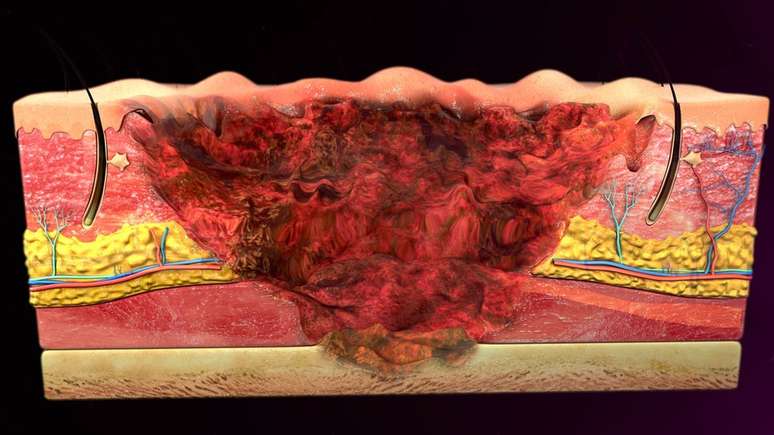 O tratamento depende da profundidade e extens&atilde;o da queimadura