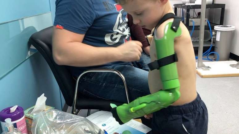 Jacob agora é capaz de segurar objetos com sua prótese funcional