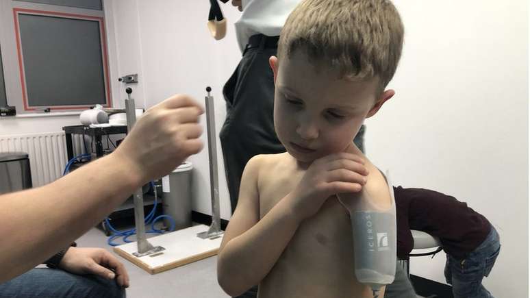 Jacob nasceu oito semanas antes do previsto, sem a maior parte do bra&ccedil;o esquerdo