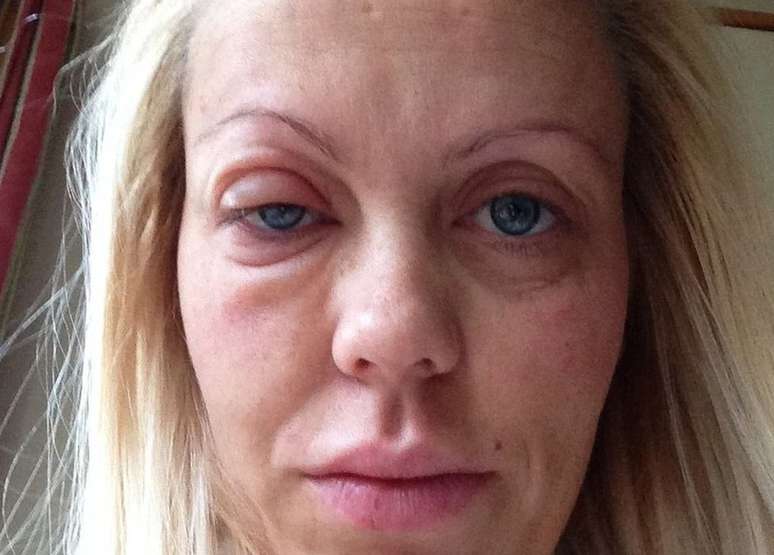 Malene passou a sofrer de fortes rea&ccedil;&otilde;es al&eacute;rgicas ap&oacute;s colocar silicone