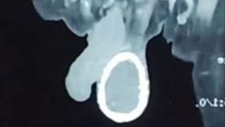Homem tem testículo "casca de ovo" devido à elefantíase - Foto: Reprodução/BMJ Case Reports