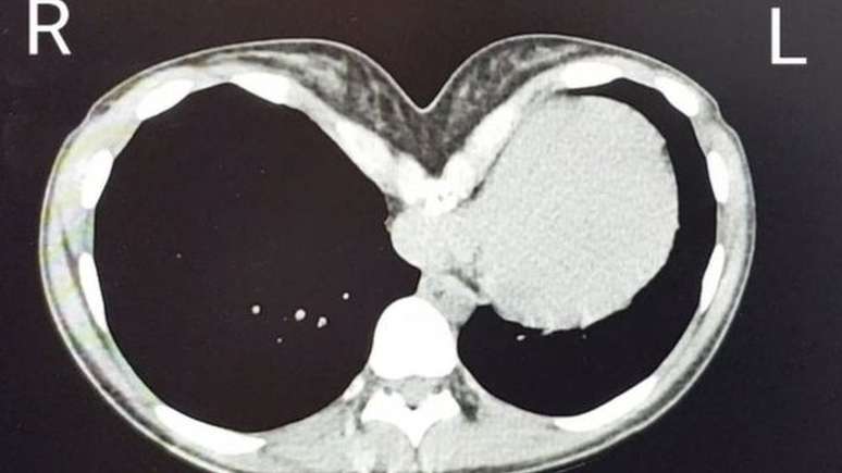 Katie diz que seu cora&ccedil;&atilde;o foi esmagado por seus ossos