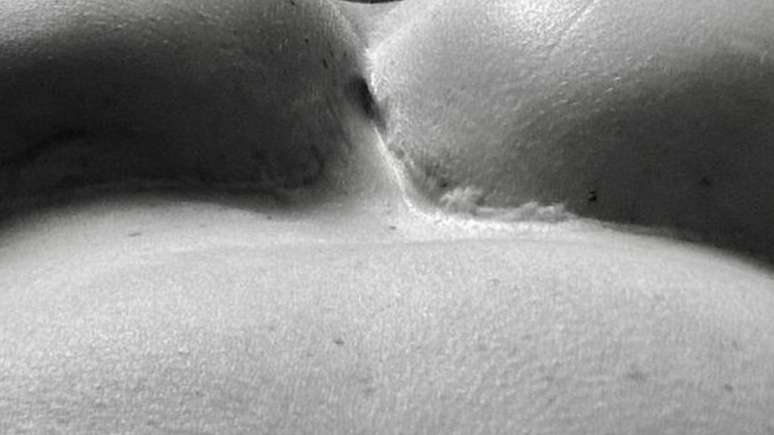 Com sua nova cirurgia, Kerry corrigir&aacute; uma opera&ccedil;&atilde;o realizada na adolesc&ecirc;ncia na &Aacute;frica do Sul