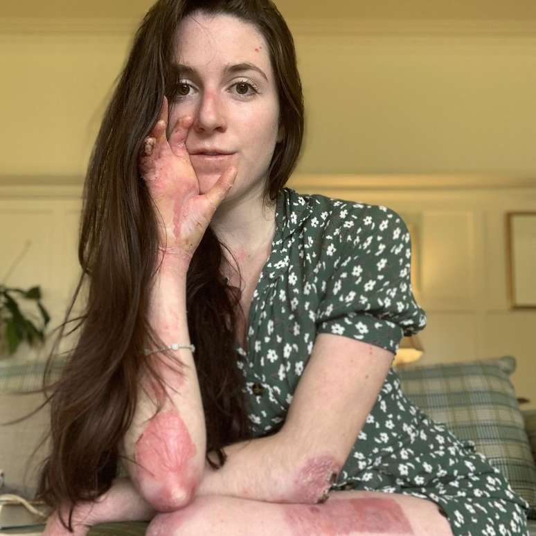 Americana Lucy Beal Lott tem 20 anos e nasceu com uma doença genética e hereditária rara chamada epidermólise bolhosa (EB)