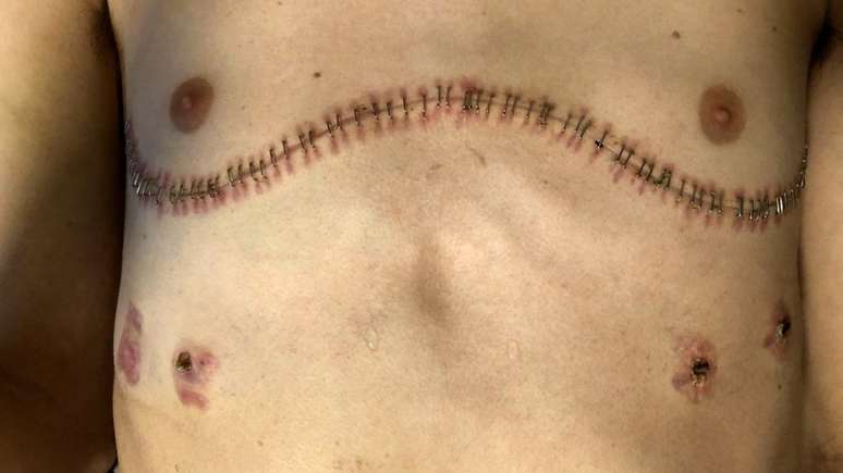 Sistema imunol&oacute;gico de Ament ainda est&aacute; fraco, e ele ter&aacute; de tomar medicamentos pelo resto da vida