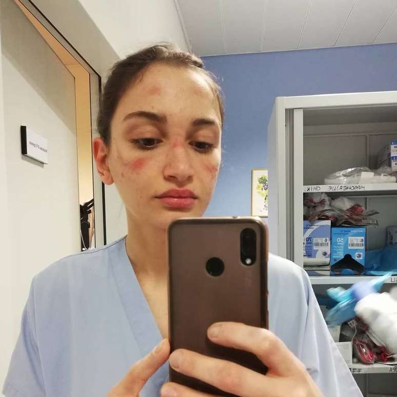 Alessia Bonari mostra seu rosto machucado pelos equipamentos de proteção