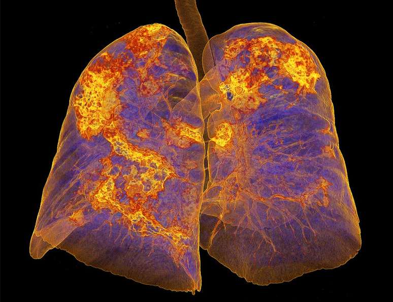 Imagem dos pulmões de uma pessoa infectada mostra áreas com pneumonia