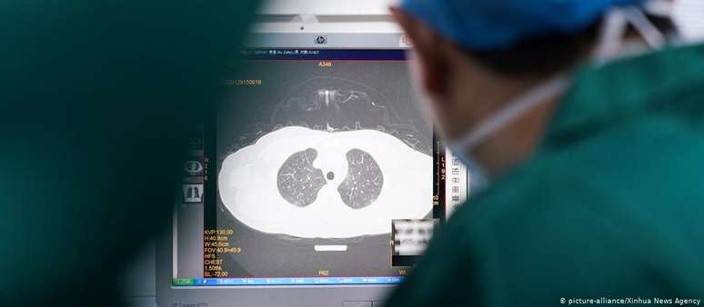 "Em alguns pacientes, a função pulmonar pode cair de 20% a 30% após a cura", afirma médico de Hong Kong