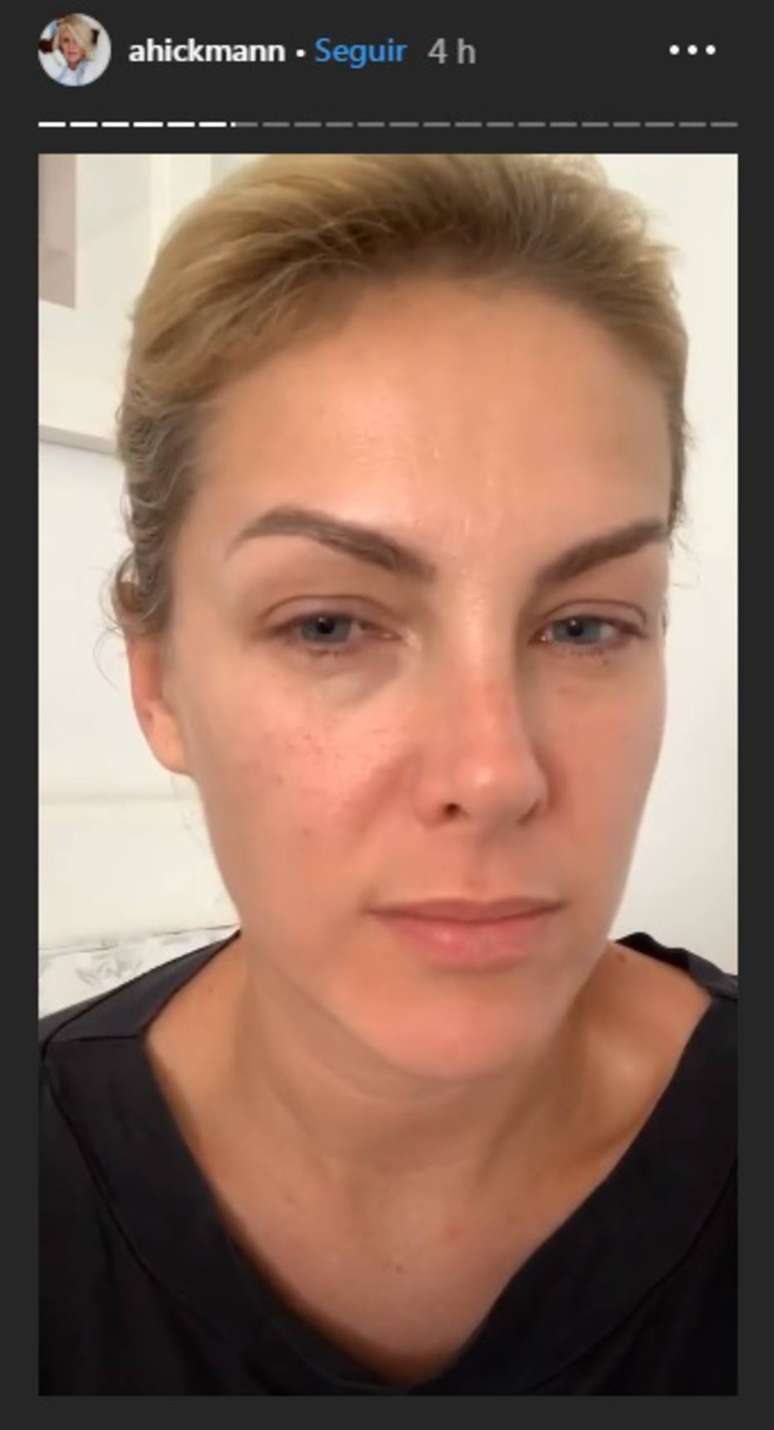 Com sintomas semelhantes aos provocados pelo novo coronavírus, Ana Hickmann mostrou que está com olhos inchados e boca ressecada.