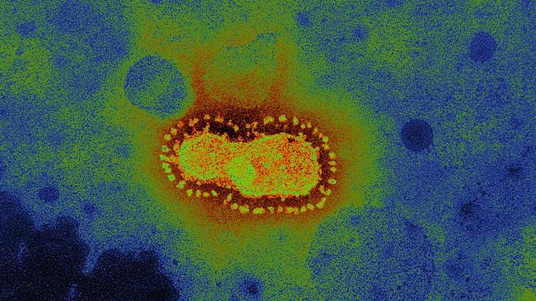 Hidroxicloroquina, usada no tratamento da malária, da artrite reumatoide e da lúpus, ganhou projeção mundial como possível solução contra o novo coronavírus