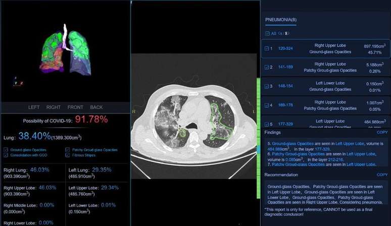 Imagem de pulmão analisado por algoritmo oferecido pelo HC 