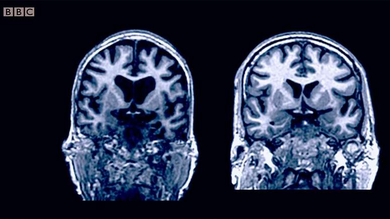 Dois cérebros de pessoas da mesma idade: o cérebro daquele à esquerda atrofiou ainda mais.