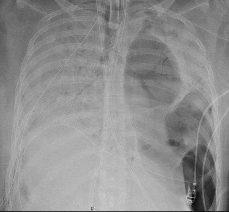 Raio-X mostra que os pulmões da paciente apresentavam danos irreversíveis