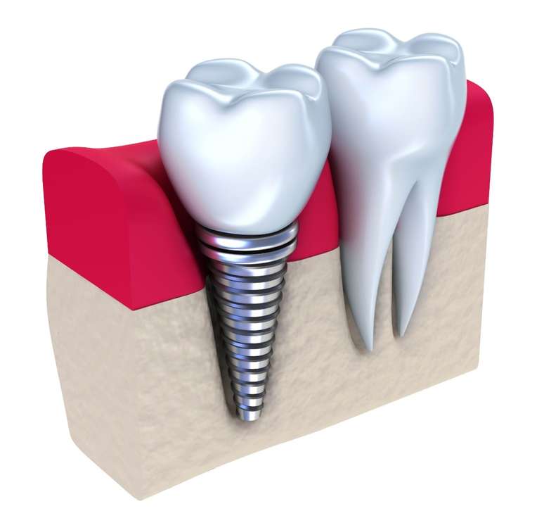 Implante Dentário