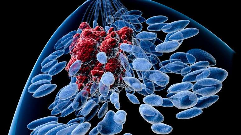 Peters defendeu uma cirurgia menos invasiva para tratar o c&acirc;ncer de mama.