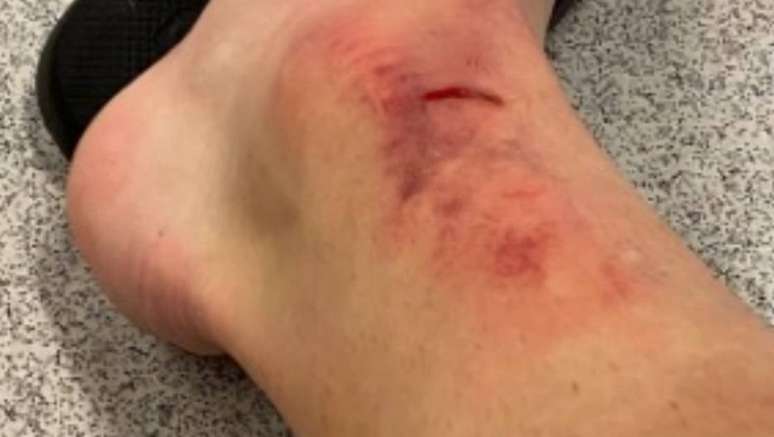Carlos Augusto, do Corinthians, posta foto de tornozelo cortado e inchado após lance em que jogador do Mirassol foi expulso