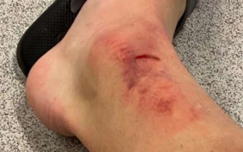 Carlos Augusto exibiu o tornozelo nas redes sociais após a partida (Foto: Arquivo Pessoal)