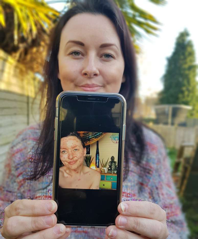 Aimee mostra uma foto de sua psor&iacute;ase