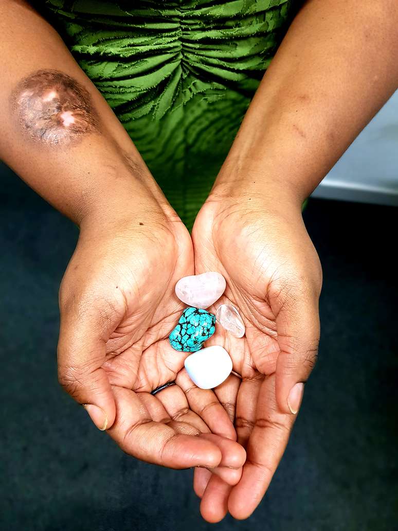 Emily tem cicatrizes de automutila&ccedil;&atilde;o