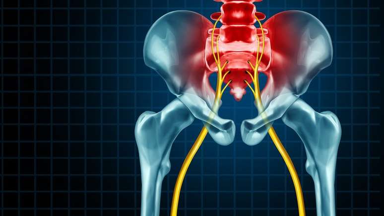 "Manter um tronco forte &eacute; a melhor forma de prevenir problemas no ci&aacute;tico", mas, caso a dor j&aacute; exista, h&aacute; exerc&iacute;cios que podem alivi&aacute;-la