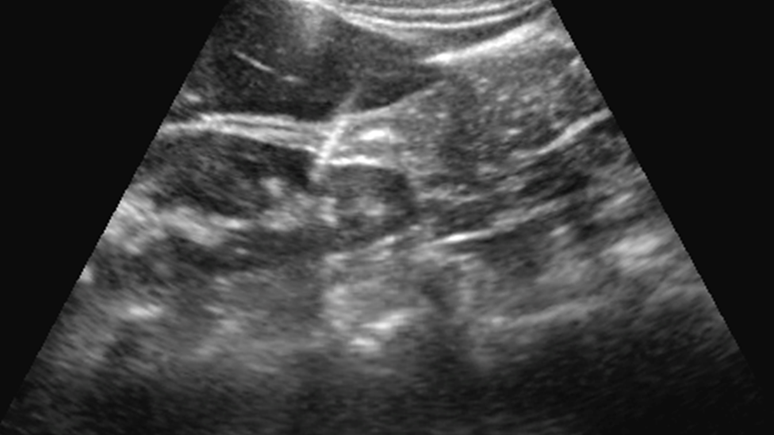 As imagens produzidas por ultrassonografia permitem que a equipe veja a posição da agulha dentro do corpo