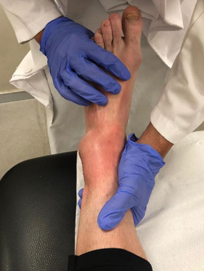 Crutchlow compartilhou uma foto de como ficou o seu pé 