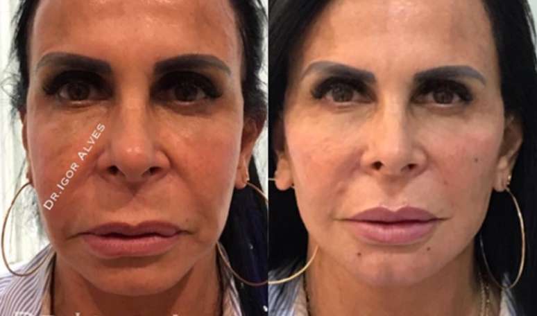 Harmonização facial: confira o antes e depois dos famosos