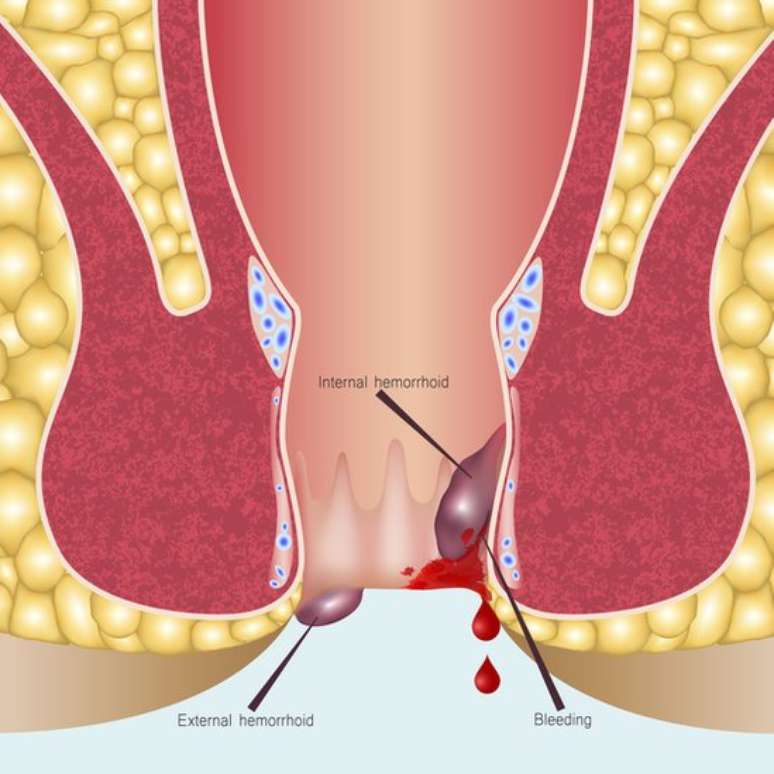 Hemorroidas podem causar ulcerações graves e dolorosas