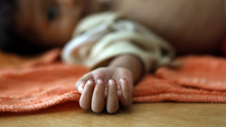 Crian&ccedil;a desnutrida no I&ecirc;men; estudo internacional prev&ecirc; 6,7 milh&otilde;es a mais de crian&ccedil;as desnutridas no mundo por causa da pandemia