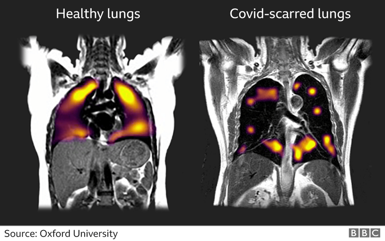 Nos pulmões com cicatrizes, à direita, há mais áreas escuras, representando partes dos pulmões que estão tendo dificuldade para transportar oxigênio para a corrente sanguínea