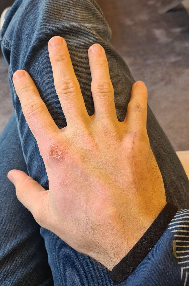 Grosjean postou evolu&ccedil;&atilde;o da m&atilde;o direita quase um m&ecirc;s ap&oacute;s acidente 