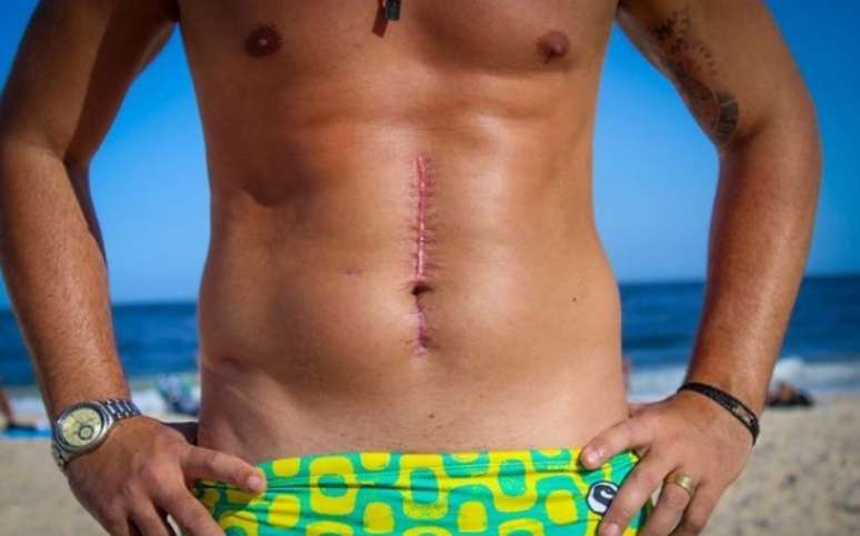 Bruno Miranda, o Borat, não tem nenhum problema em mostrar a cicatriz da cirurgia que salvou sua vida