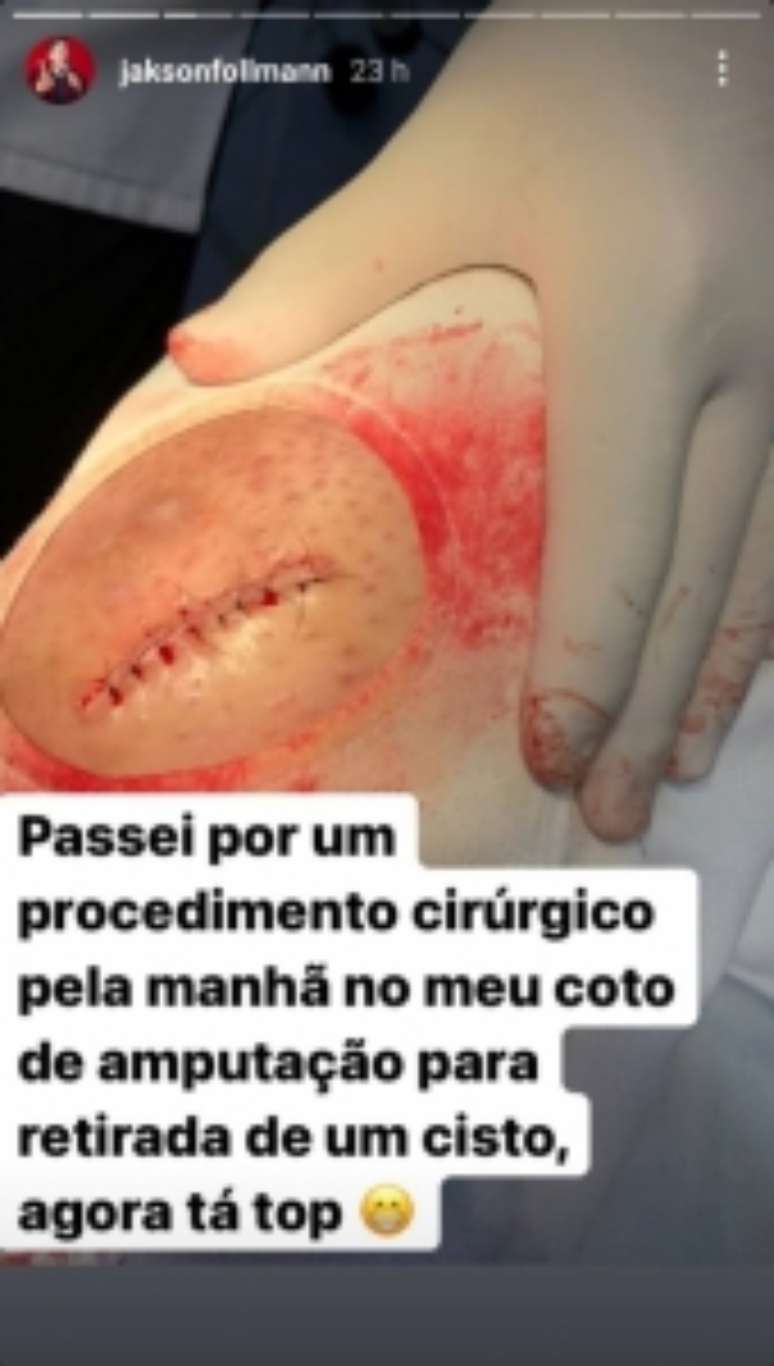 Jakson Follmann mostra pós cirurgia (Foto: Reprodução/Instagram)