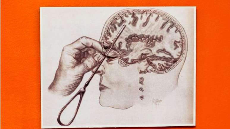 Diagrama de uma lobotomia transorbital