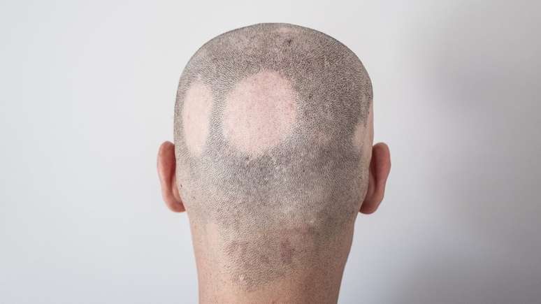 Pacientes com predisposição genética ou doenças autoimunes, por exemplo, que podem apresentar quedas em forma de rodelas, condição conhecida como alopecia areata