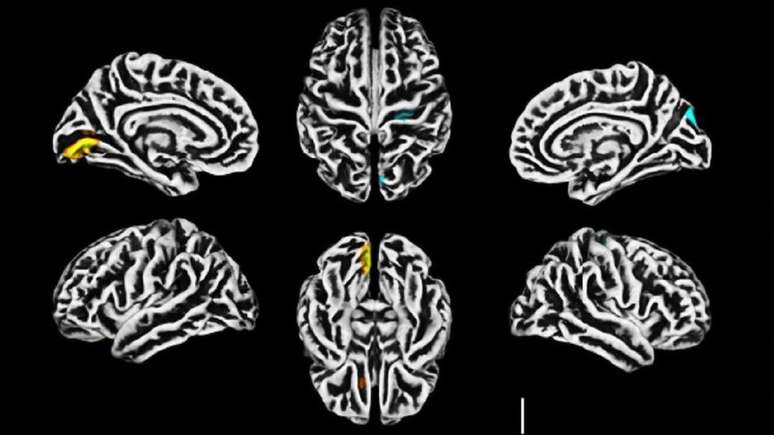 Ressonância magnética mostra alterações na estrutura do córtex cerebral; em amarelo, a redução na espessura cortical; em azul, o aumento da espessura