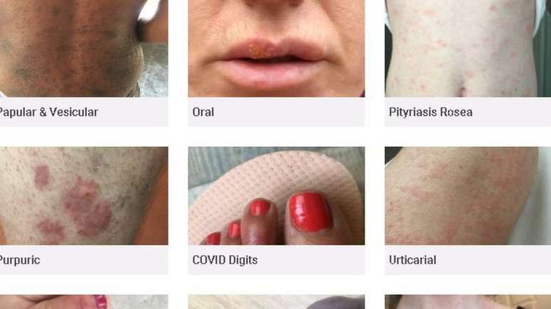 Cientistas do King's College London montaram um banco de imagens online com manifestações dermatológicas pelo coronavírus