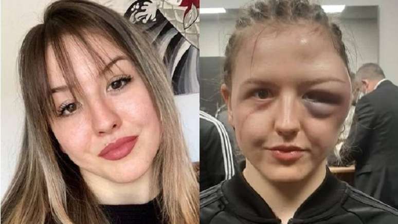  Cheyenne Hanson, de 23 anos, ficou com parte do rosto desfigurado por causa de um enorme hematoma que surgiu no lado esquerdo de sua face