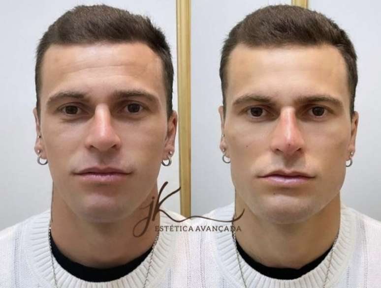 Exercício Para O Rosto Harmonização Facial Mewing Resultados em, mewing  funciona 