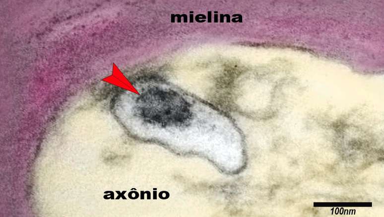 A imagem mostra um axônio de um neurônio do cérebro de uma criança com síndrome inflamatória multissistêmica pediátrica (SIM-P). A seta aponta o vírus SARS-CoV-2 em uma vesícula no citoplasma do axônio