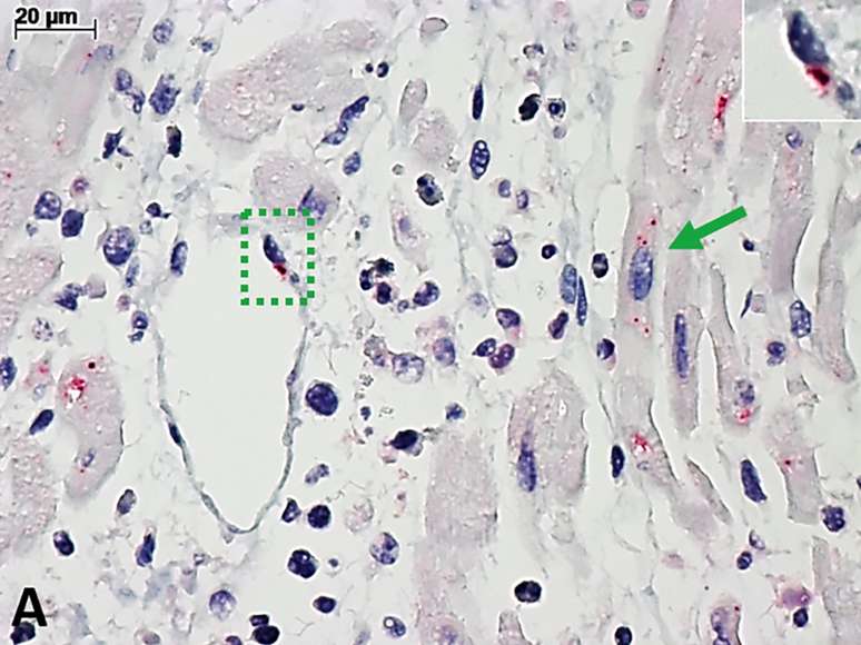 Coração de criança com miocardite pela covid-19, observado pelo microscópio comum. A coloração vermelha marca a infecção pelo vírus SARS-CoV-2. No quadrado pontilhado em verde (e no detalhe): célula de vaso sanguíneo. Na seta verde: célula de músculo cardíaco.