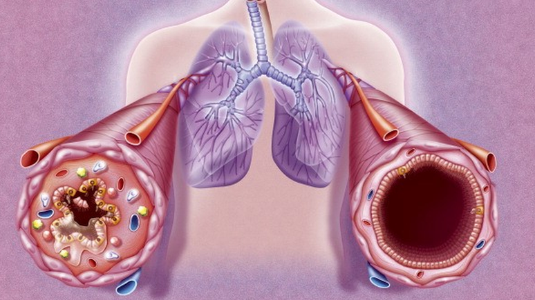 A asma é uma doença crônica em que os brônquios, tubos por onde o ar passa, sofrem com inflamações e podem fechar (como ilustrado à esquerda) durante as crises. Isso causa falta de ar e outras complicações