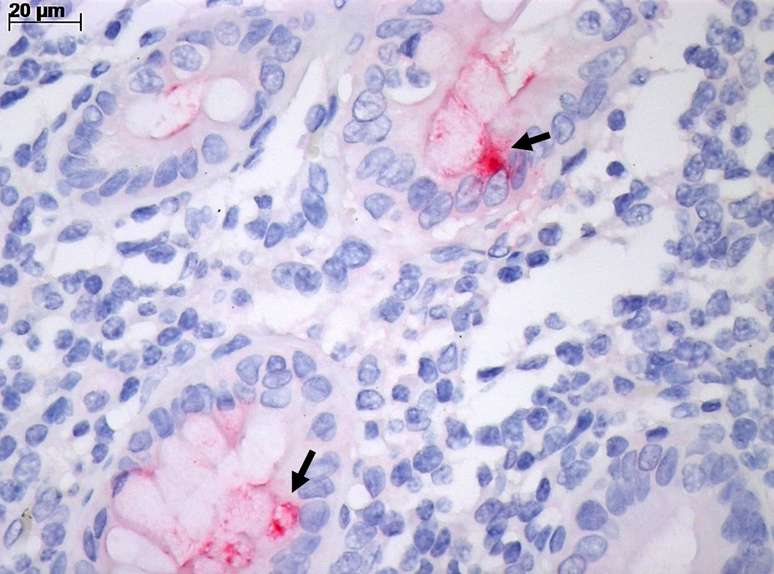 Intestino com inflamação pela covid-19, observado pelo microscópio comum. A coloração vermelha (seta) marca a infecção de célula intestinal pelo vírus SARS-CoV-2.