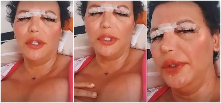 Luisa Marilac na primeira aparição na internet após a cirurgia: complicações do silicone industrial colocaram sua vida em risco