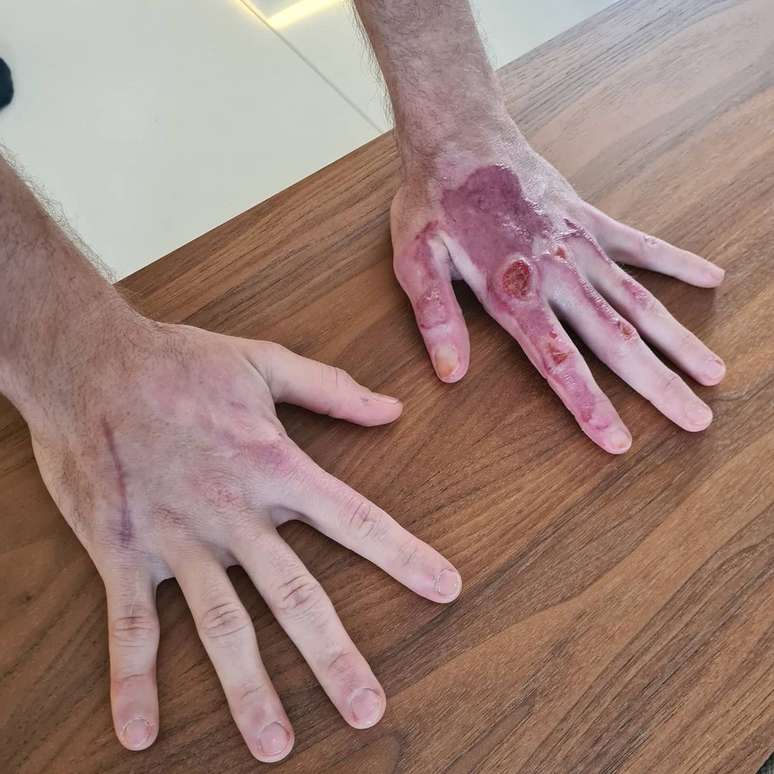 As mãos de Romain Grosjean sem curativos 