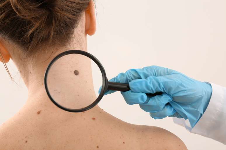 O melanoma pode ocorrer na pele, nos olhos, orelhas e até no trato gastrointestinal