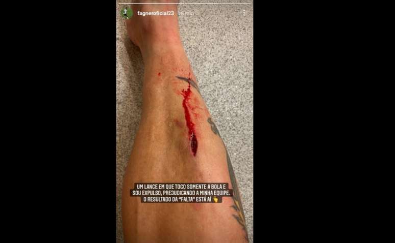 Fagner postou uma imagem forte de um corte em sua canela após o jogo (Foto: Reprodução/Instagram Fagner)