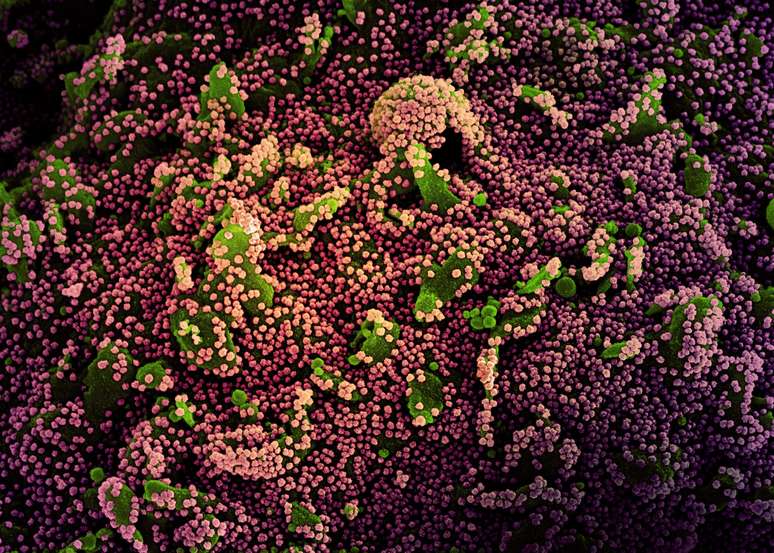 Célula (verde) fortemente infectada com partículas do vírus da covid-19 (roxo)