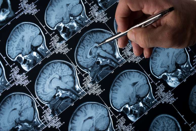 O Aducanumab visa remover os depósitos pegajosos de uma proteína chamada beta amilóide dos cérebros de pacientes em estágios iniciais de Alzheimer 