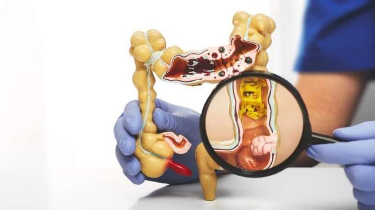 Em geral, os divertículos se desenvolvem no sigmoide, parte inferior esquerda do intestino grosso